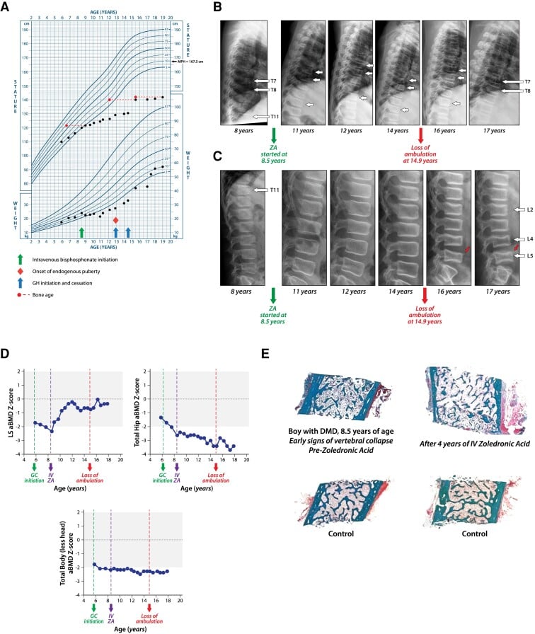Longitudinal growth, lateral spine radiographs and bone-density data in a boy with Duchenne muscular dystrophy treated with intravenous zoledronic acid.