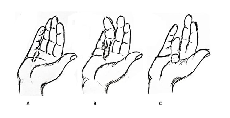 Three drawings, panels A to C, of a palm showing a nodule with skin tethering, a longitudinal cord and a finger drawn into flexion