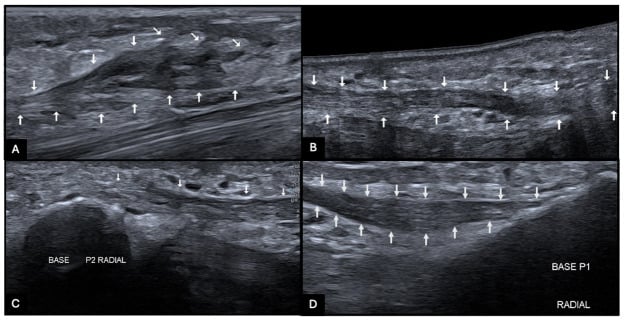 Four ultrasound panels, A to D, with arrows outlining a superficial hyperechoic Dupuytren cord along the finger