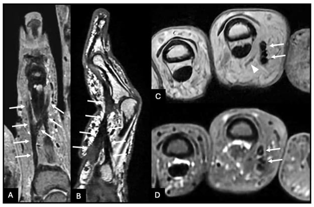 MRI of a Dupuytren digital cord in four panels, arrows on the cord splitting distally and an arrowhead on the displaced radial neurovascular bundle
