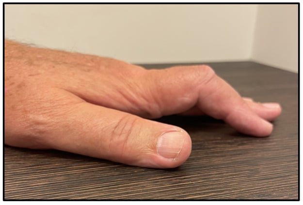 Index finger held in PIP flexion by a Dupuytren digital cord, a pseudo-boutonnière posture