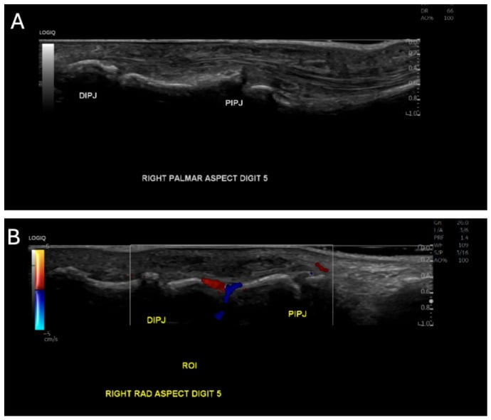 Ultrasound of the right little finger from the palmar and radial aspects, the radial view with colour Doppler, in a distal Dupuytren cord