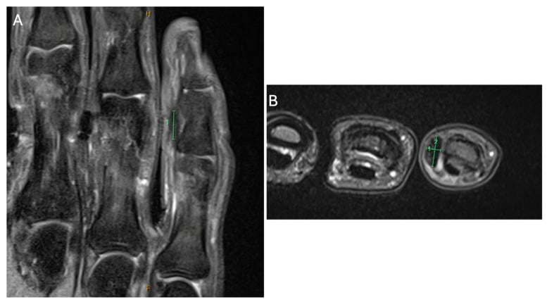Coronal and axial MRI of a distal Dupuytren lesion with measurement callipers