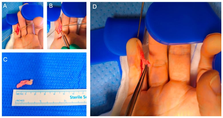 Operative exposure and excision of a distal Dupuytren cord, with the excised specimen beside a ruler
