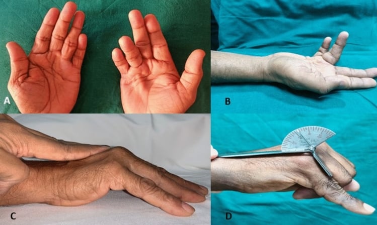 Four clinical photographs, panels A to D: both palms, a contracted finger from the side, a tabletop test and goniometry of a finger joint
