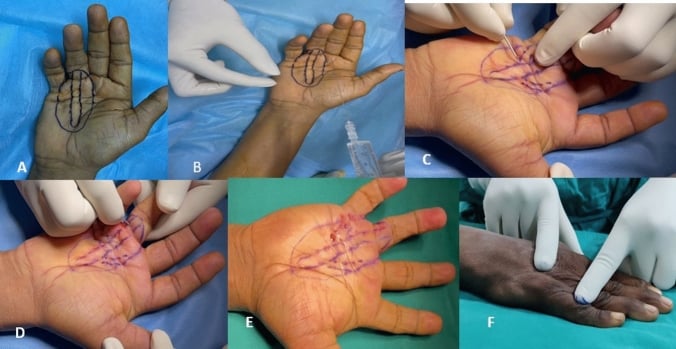Percutaneous needle aponeurotomy in six panels, from skin marking and local anaesthesia through needle division to a hand lying flat