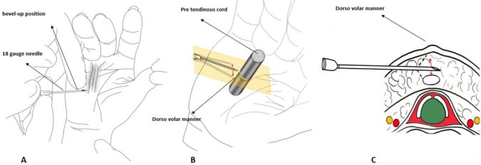 Drawings of safe needle orientation in aponeurotomy: a bevel-up needle, dorsovolar movement across the pretendinous cord, and the same movement in cross-section