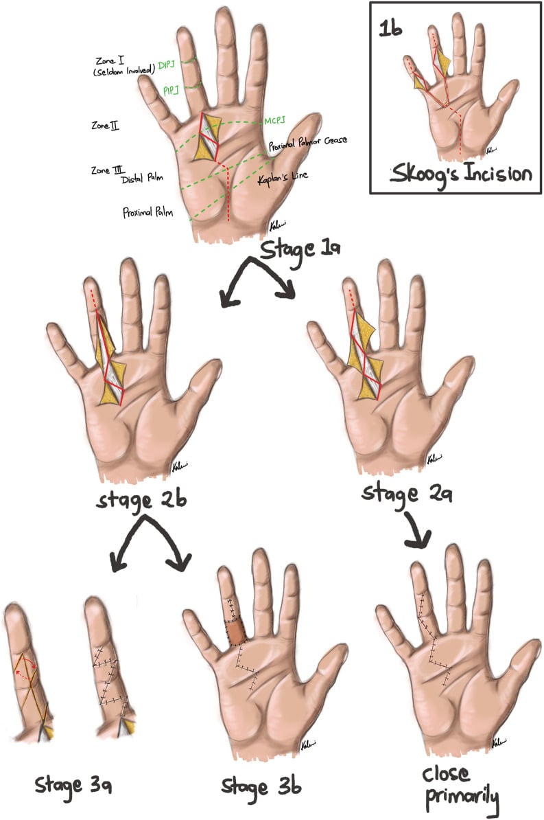 Staged incision-planning drawings for fasciectomy, from a palmar zigzag and Skoog's incision to primary closure, Z-plasty or a graft