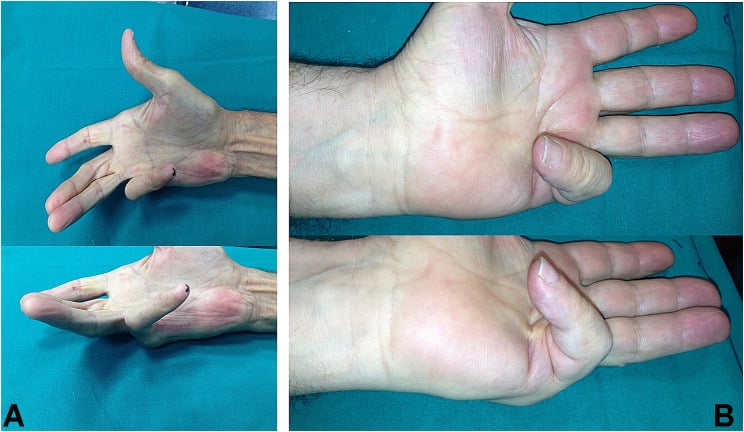 Advanced Tubiana stage III and IV little-finger Dupuytren contractures in two patients, each photographed in two views