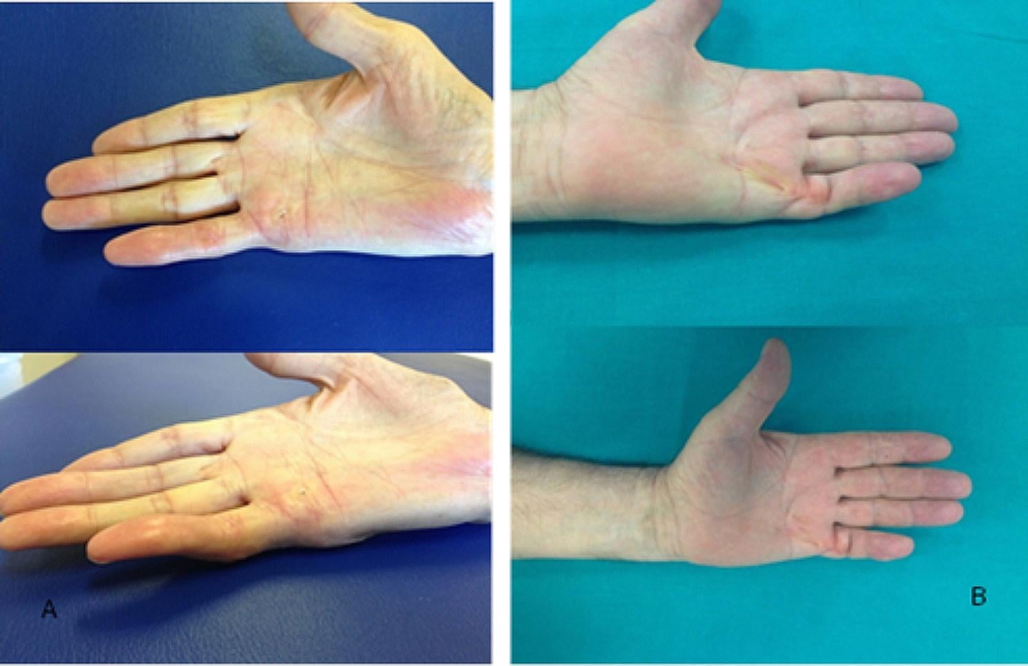 Two hands after treatment of advanced little-finger Dupuytren contracture, each photographed in two views with the fingers largely extended