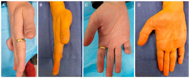 Right little finger before and after excision of a distal Dupuytren cord, in lateral and volar views