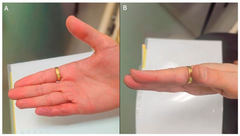 Volar and lateral views of the finger twelve months after distal Dupuytren cord excision, with extension maintained