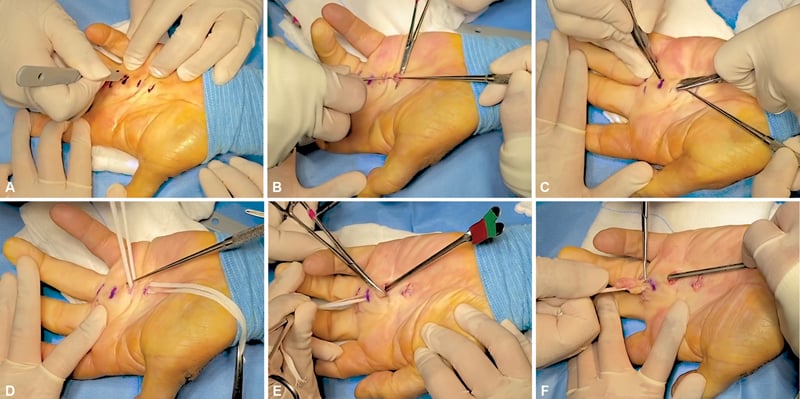 Limited-incision pull-through fasciectomy through several short transverse incisions, in six operative panels