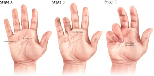 Stages of Dupuytren's disease progression
