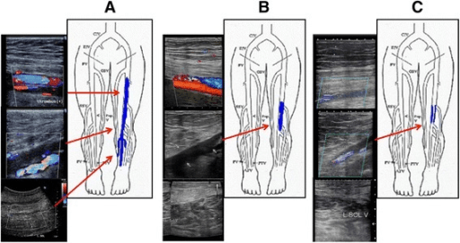 Serial ultrasound panels with schematic showing a left lower-limb deep vein thrombus regressing with anticoagulation
