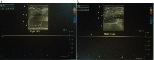 Duplex ultrasound of the right common femoral and popliteal veins showing absent venous flow in deep vein thrombosis