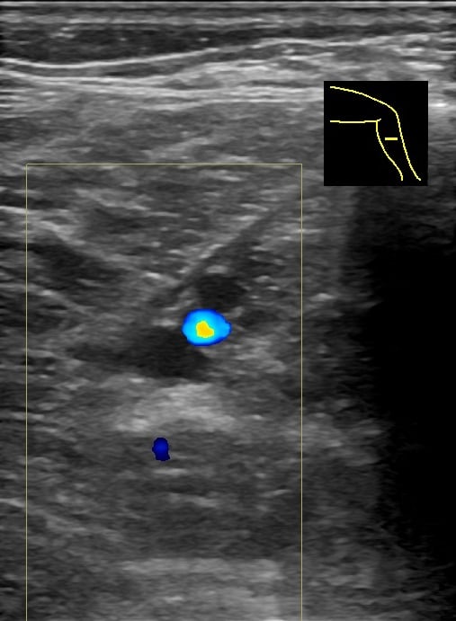 Ultrasound demonstrating thrombosis in the fibular (peroneal) veins of the calf
