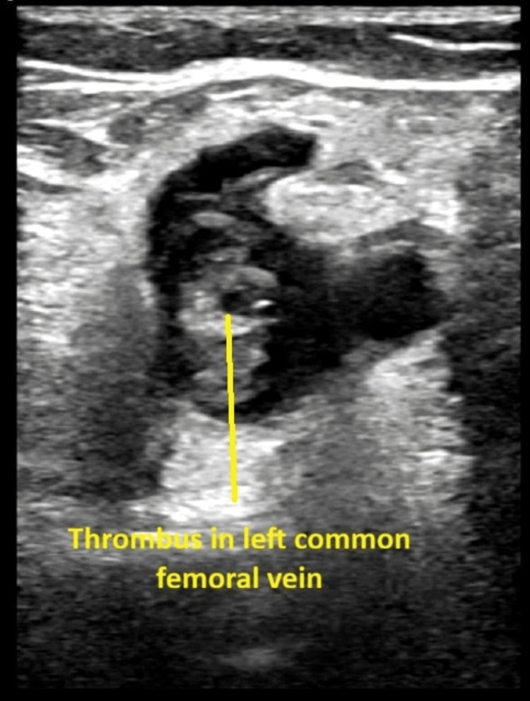 Ultrasound image demonstrating occlusive thrombus in the common femoral vein