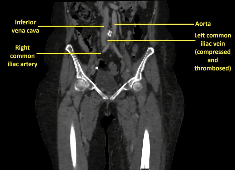 Coronal CT venogram demonstrating iliac vein compression and thrombosis in May-Thurner syndrome