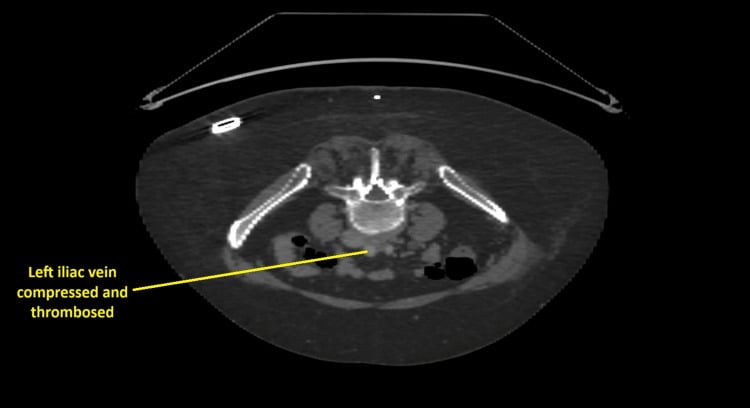 Axial CT scan of the pelvis demonstrating iliac vein compression and thrombosis