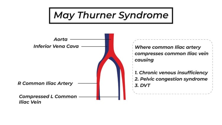 Anatomical diagram of May-Thurner syndrome showing iliac vein compression