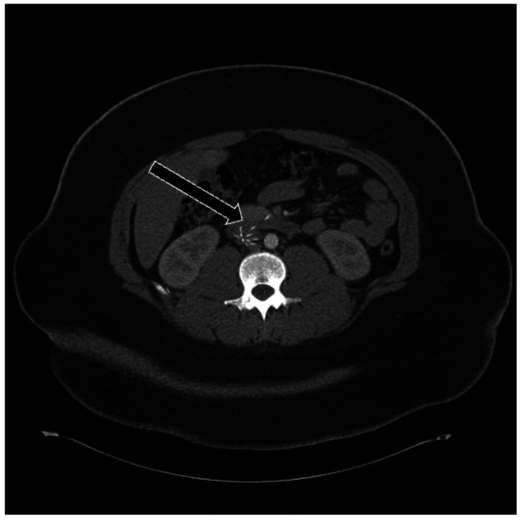 Axial CT scan of the abdomen demonstrating an infrarenal IVC filter