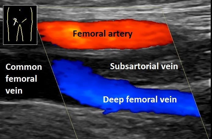 Colour-Doppler ultrasound of the normal femoral vessels labelling the femoral artery, common femoral vein and deep femoral vein