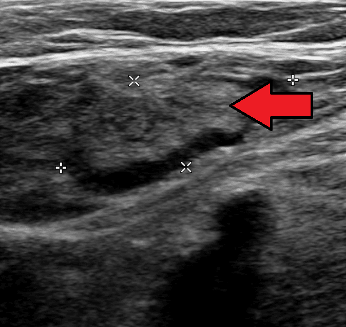 Groin ultrasound showing a distended thrombus-filled common femoral vein marked by an arrow, with measurement calipers