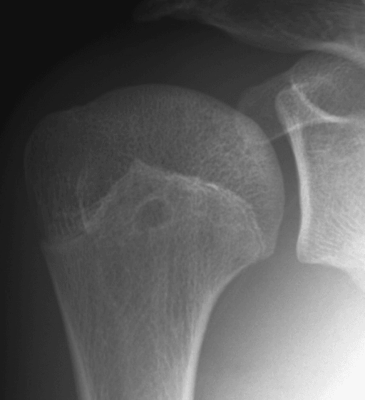 AP shoulder radiograph showing a sclerotic-rimmed lucent lesion in a single humeral head