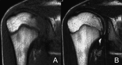 Two-panel coronal oblique T1-weighted MRI of one shoulder showing a low-signal band within the humeral head