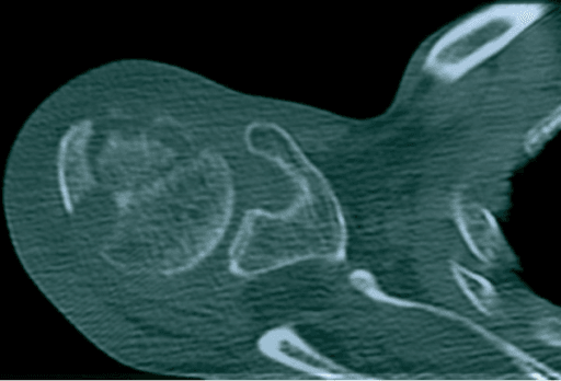 Axial CT through the proximal humerus showing mottled lucency and sclerosis with subchondral crescentic lucency