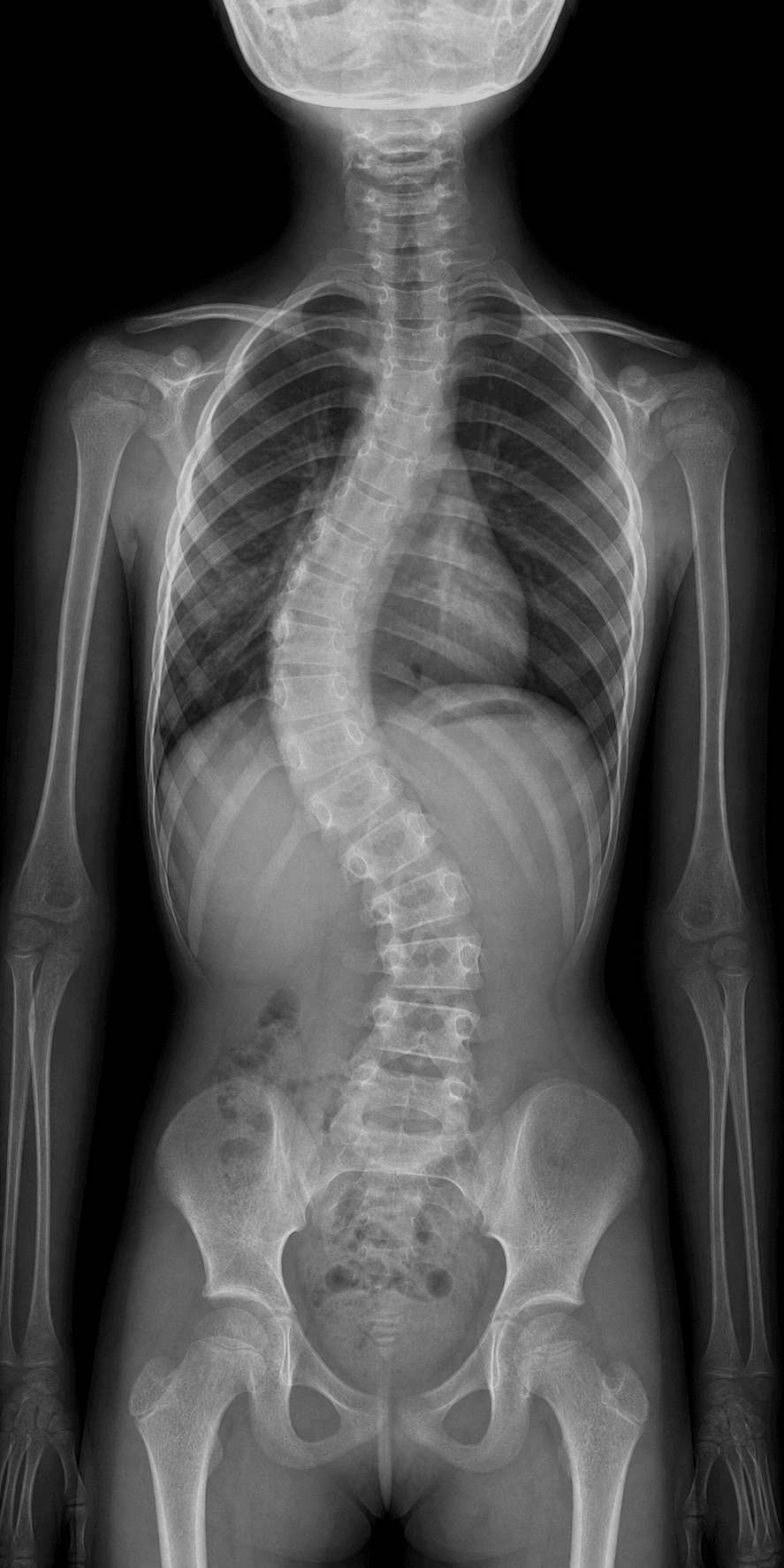 early-onset scoliosis spine radiograph