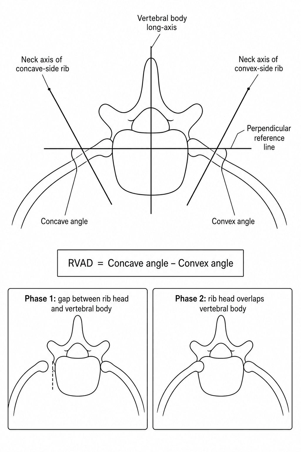 Schematic diagram of how the Rib-Vertebral Angle Difference (RVAD, Mehta angle) is measured