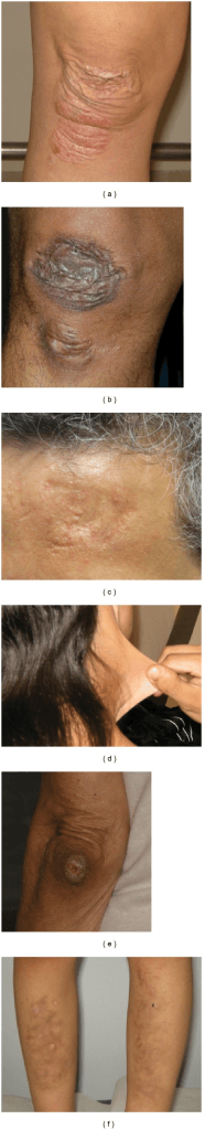 Ehlers-Danlos Syndrome composite clinical photographs: atrophic cigarette-paper scarring over the knee, shin and forehead, a demonstration of skin hyperextensibility, and a subcutaneous nodule.
