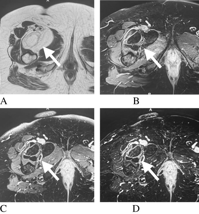 Multisequence MRI of an atypical lipomatous tumour with thick enhancing septa