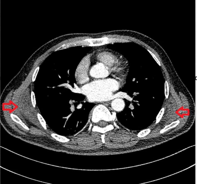 Axial CT showing bilateral symmetric subscapular elastofibroma dorsi masses