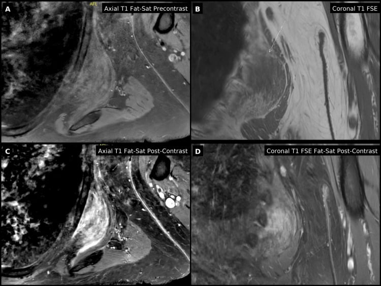 Multiplanar pre-procedure MRI of a striated subscapular elastofibroma