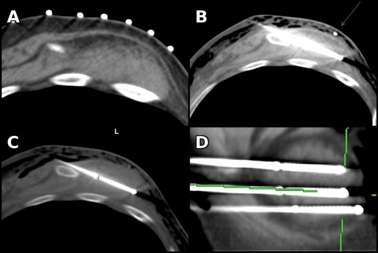 CT-guided cryoablation planning and probe placement for elastofibroma dorsi