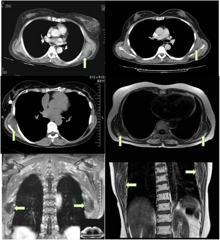 Multiplanar CT and MRI examples of elastofibroma dorsi with interspersed fat strands