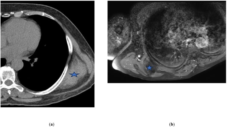 Axial CT and T1-weighted MRI of elastofibroma dorsi