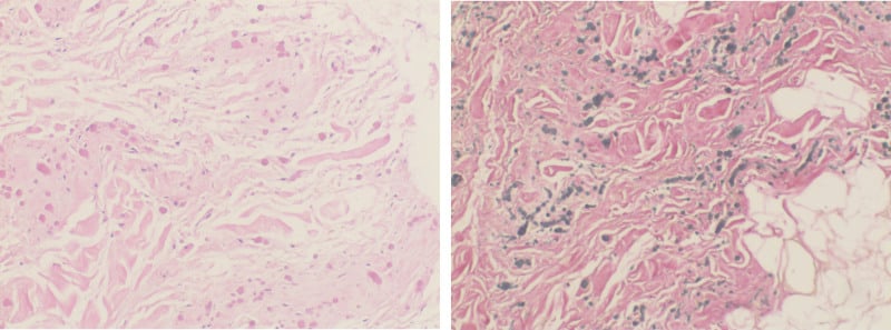 Histology of elastofibroma dorsi showing elastic fibres, collagen and mature fat