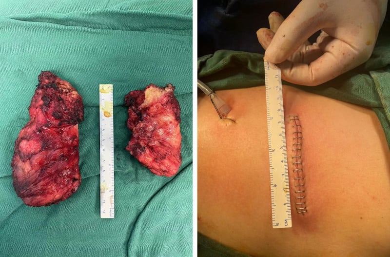 Elastofibroma dorsi resection specimen and infrascapular operative incision
