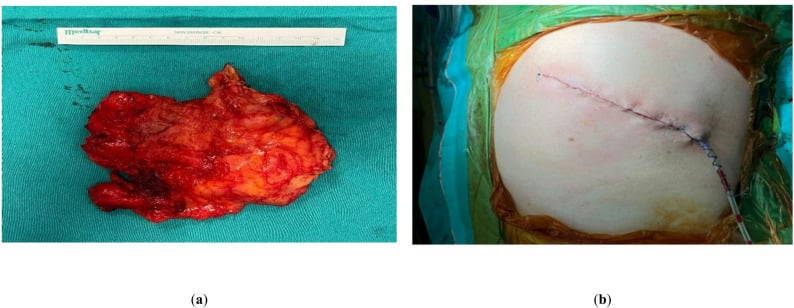 Gross elastofibroma specimen and closed infrascapular incision with suction drain