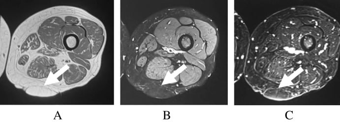 Multisequence MRI of a benign lipoma with thin non-enhancing septa