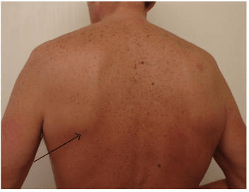 Clinical photograph of a patient's back from behind with an arrow pointing to a soft swelling at the inferior pole of the left scapula - the typical site of elastofibroma dorsi