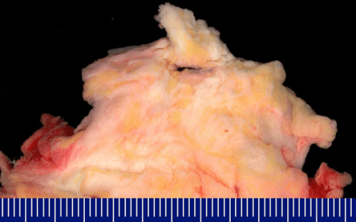 Macroscopic surgical specimen of elastofibroma dorsi against a ruler, showing a poorly defined firm mass of grey-white fibrous tissue admixed with yellow mature fat