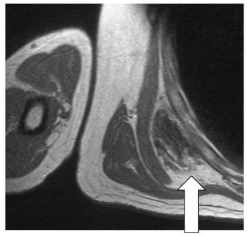 Axial T1-weighted MRI of the chest wall showing an ill-defined soft-tissue mass deep to the serratus anterior at the inferior scapular region, with signal similar to skeletal muscle interlaced with thin streaks of fat, indicated by an arrow