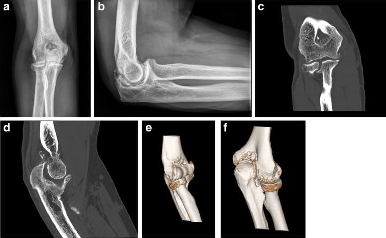 Radiographs and CT of primary elbow osteoarthritis