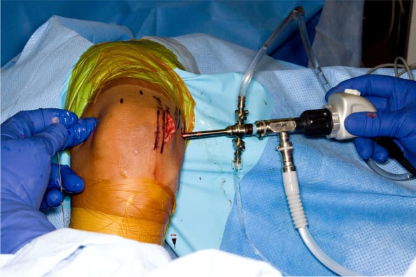 Elbow arthroscopy with a closed incision from in situ ulnar nerve decompression