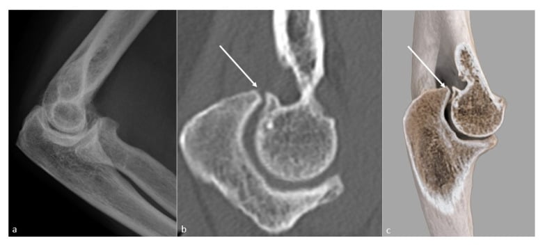 Trochlear osteophyte causing extension block on CT